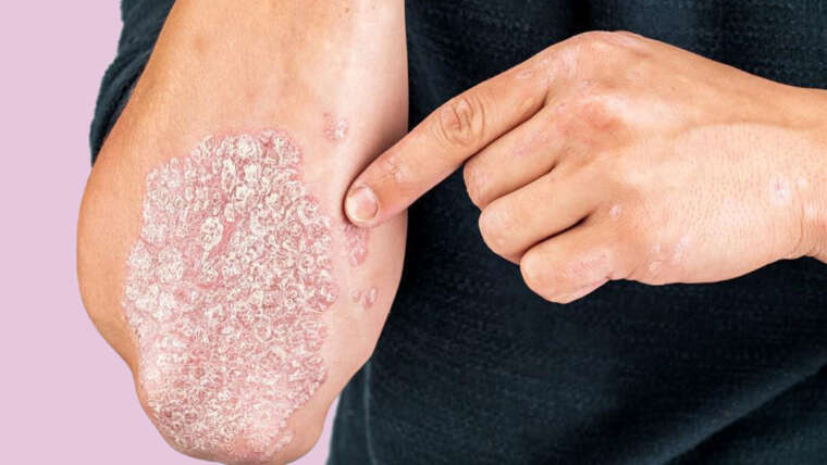 PSORIASIS