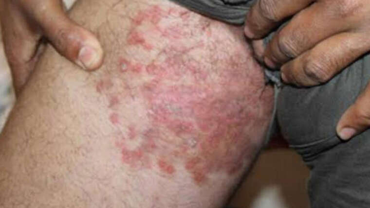 TINEA (FUNGAL INFECTION)