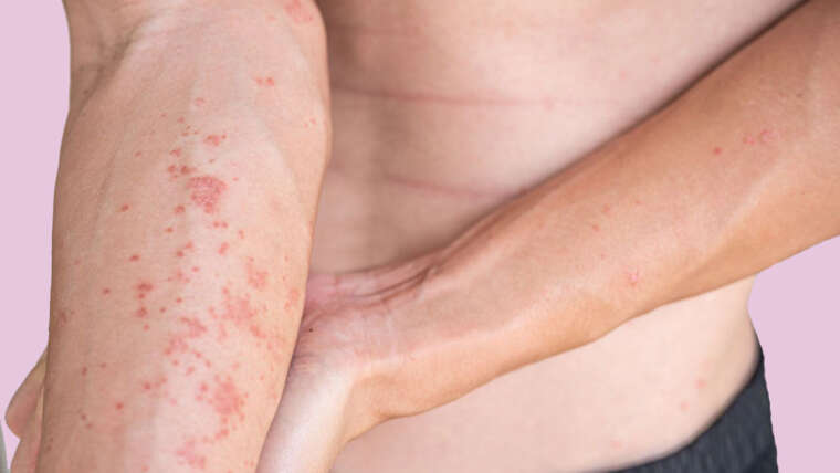 ATOPIC DERMATITIS