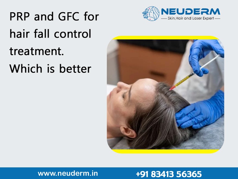 PRP and GFC for hair fall control treatment. Which is better?