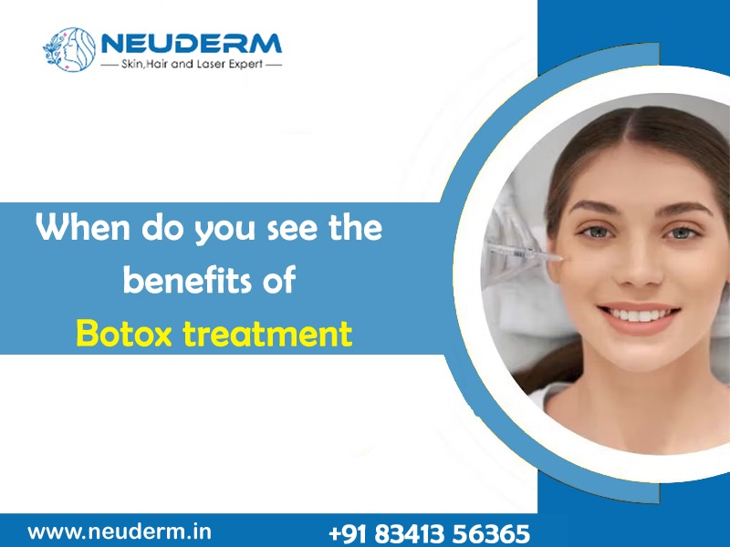 When do you see the benefits of Botox treatment?
