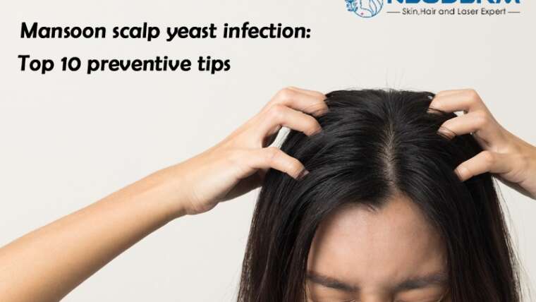 Monsoon scalp yeast infection: Top 10 preventive tips