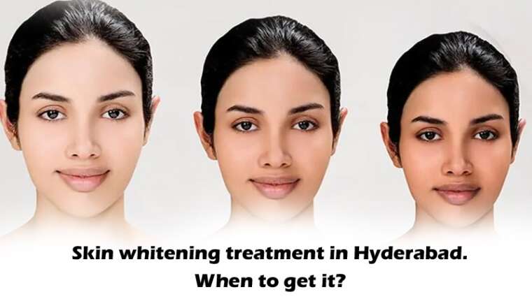 Skin whitening treatment in Hyderabad. When to get it?