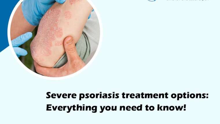 Severe psoriasis treatment options: Everything you need to know!