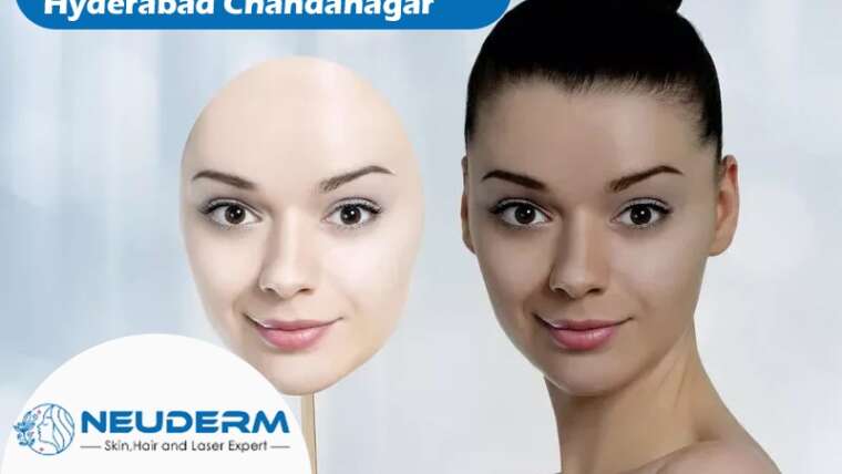 NeuDerm skin whitening treatment in Hyderabad Chandanagar