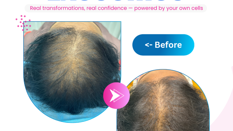 Exosomes for Hair: The Breakthrough Solution to Hair Loss You’ve Been Waiting For