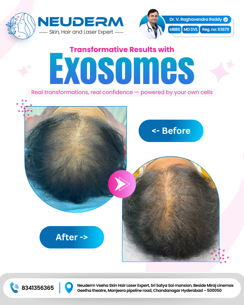 Exosomes for Hair: The Breakthrough Solution to Hair Loss You’ve Been Waiting For